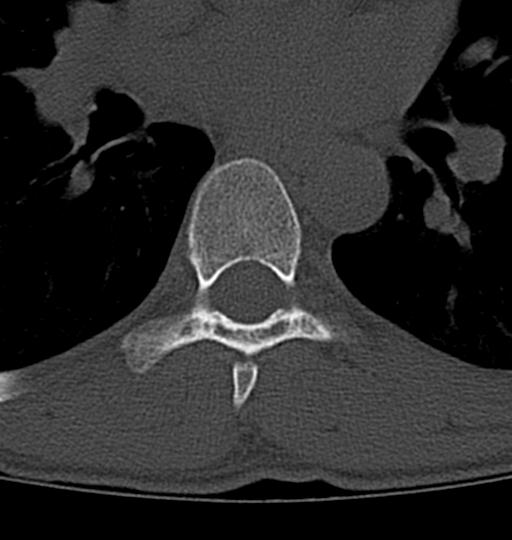 File:Aneurysmal bone cyst T11 (Radiopaedia 29294-29721 Axial bone window 5).jpg