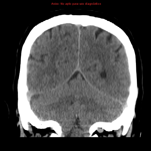 File:Aneurysmal subarachnoid hemorrhage (Radiopaedia 24740-24997 Coronal non-contrast 36).jpg