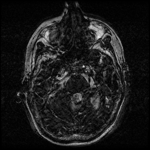 Angioinvasive aspergillosis in the pituitary fossa (Radiopaedia 39676-42010 Ax 3D FIESTA VOLUME 29).png