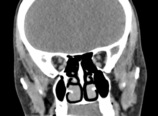 Angular dermoid cyst (Radiopaedia 88967-105790 Coronal non-contrast 39).jpg