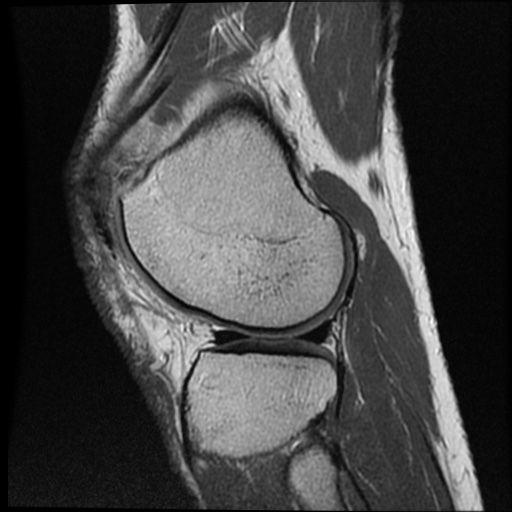 File:Anomalous insertion of the medial meniscus (Radiopaedia 77559-89721 Sagittal PD 16).jpg