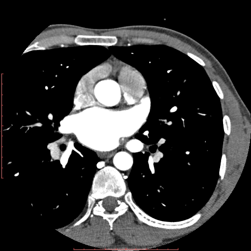 Anomalous left coronary artery from the pulmonary artery (ALCAPA) (Radiopaedia 70148-80181 A 86).jpg