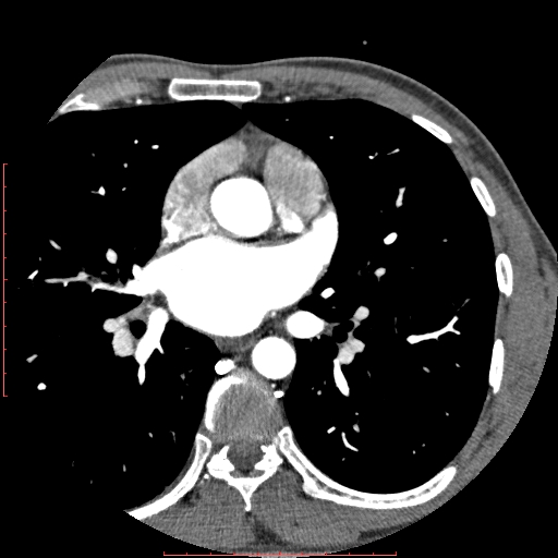 File:Anomalous left coronary artery from the pulmonary artery (ALCAPA) (Radiopaedia 70148-80181 A 92).jpg