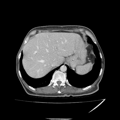 File:Anorectal carcinoma (Radiopaedia 44413-48064 A 9).jpg
