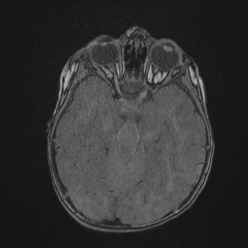 Anoxic brain injury (Radiopaedia 79165-92139 Axial MRA 83).jpg