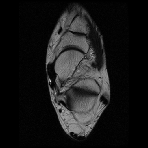 File:Anterior calcaneal process fracture (Radiopaedia 74654-85611 Axial T2 14).jpg