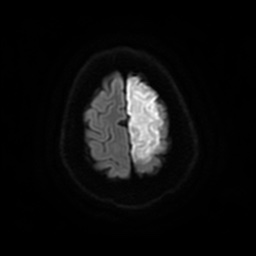Anterior cerebral artery infarction (Radiopaedia 46794-51323 Axial DWI 25).jpg