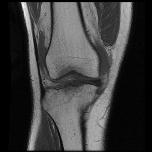 File:Anterior cruciate ligament avulsion fracture (Radiopaedia 58939-66193 Coronal T1 7).jpg