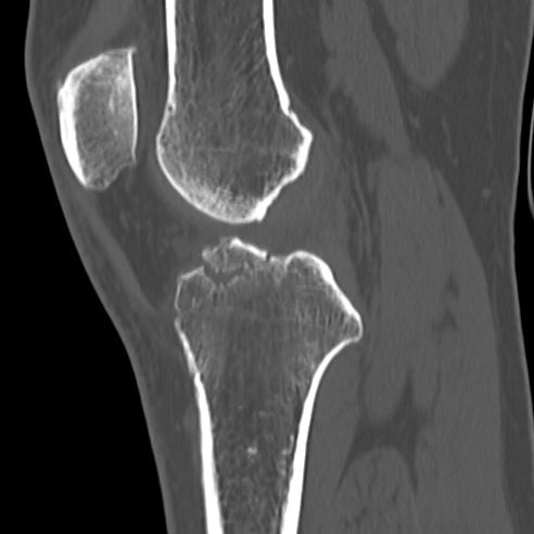 File:Anterior cruciate ligament avulsion fracture (Radiopaedia 58939-66194 Sagittal bone window 21).jpg