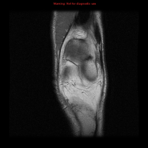 File:Anterior cruciate ligament injury - partial thickness tear (Radiopaedia 12176-12515 Coronal PD 3).jpg