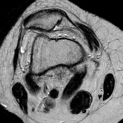 File:Anterior cruciate ligament mucoid degeneration (Radiopaedia 60853-68633 Axial T2 24).jpg