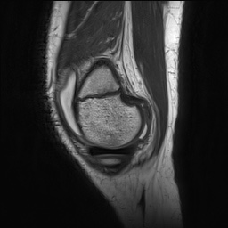 File:Anterior cruciate ligament tear - pediatric (Radiopaedia 62152-70260 Sagittal PD 35).jpg