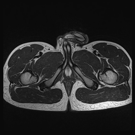 File:Anterior inferior iliac spine avulsion fracture (Radiopaedia 81312-95000 Axial T2 2).jpg