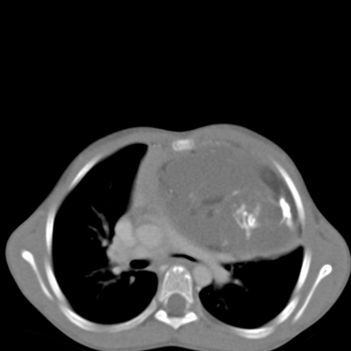 File:Anterior mediastinal teratoma (Radiopaedia 8593-9427 Axial 1).jpg
