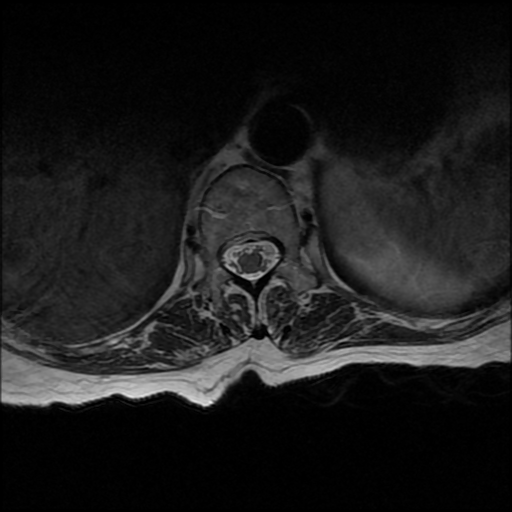 File:Anterior spinal artery syndrome (Radiopaedia 46335-50750 Axial T2 24).png