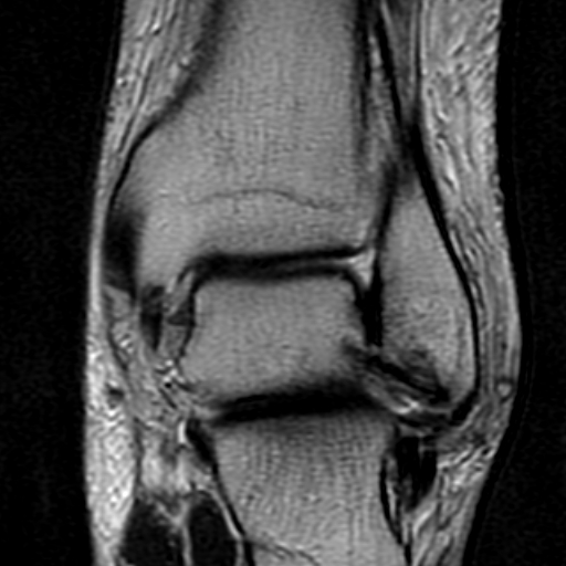 File:Anterior talofibular ligament rupture (Radiopaedia 15831-15484 Coronal T2 14).jpg