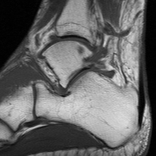 File:Anterior talofibular ligament rupture (Radiopaedia 15831-15484 Sagittal T1 7).jpg