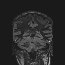 Anterior temporal encephalocele (Radiopaedia 82624-96808 Coronal FLAIR 34).jpg