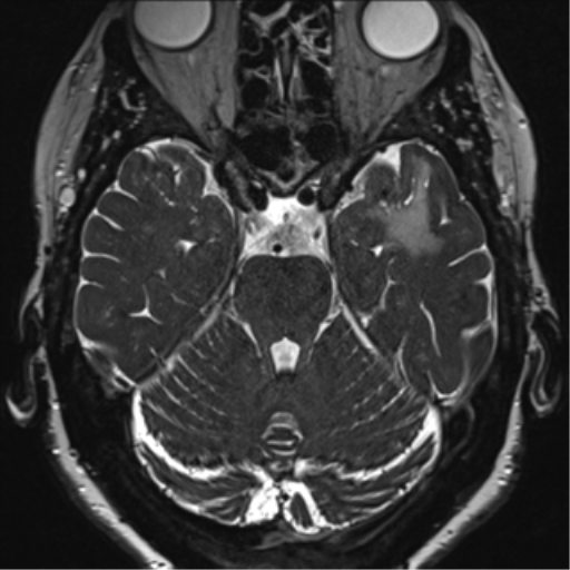 Anterior temporal pole cysts (Radiopaedia 46629-51102 Axial 32).png