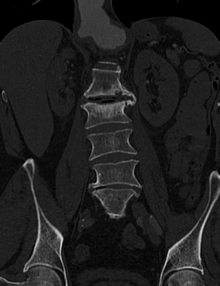 Anterior vertebral scalloping (abdominal aortic aneurysm) (Radiopaedia 66744-76067 Coronal bone window 33).jpg