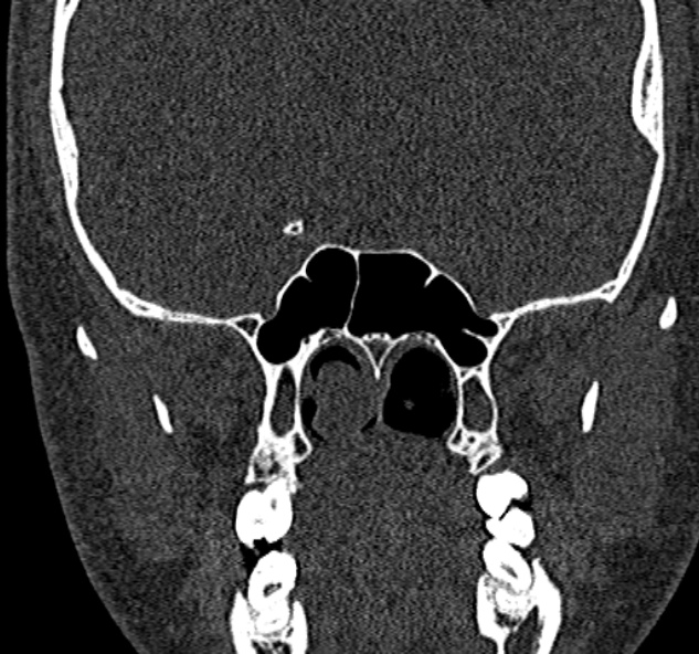 Antrochoanal polyp (Radiopaedia 30002-30554 Coronal bone window 60).jpg