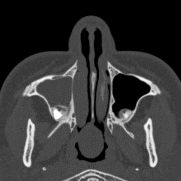 Antrochoanal polyp (Radiopaedia 33984-35202 Axial bone window 15).jpg