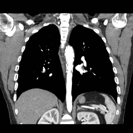 File:Aortic arch stent (Radiopaedia 30030-30595 F 21).jpg