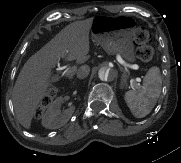 Aortic dissection (CTPA) (Radiopaedia 75506-86750 A 94).jpg