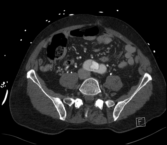 Aortic dissection (CTPA) (Radiopaedia 75506-86750 E 101).jpg