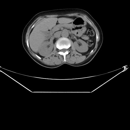 File:Aortic dissection (Radiopaedia 25350-25604 B 46).jpg