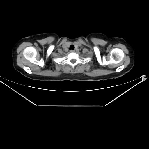 Aortic dissection (Radiopaedia 25350-25604 B 7).jpg