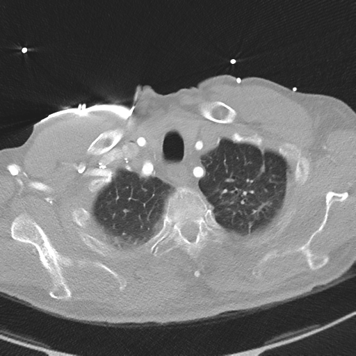 File:Aortic dissection - DeBakey type II (Radiopaedia 64302-73082 Axial lung window 9).png