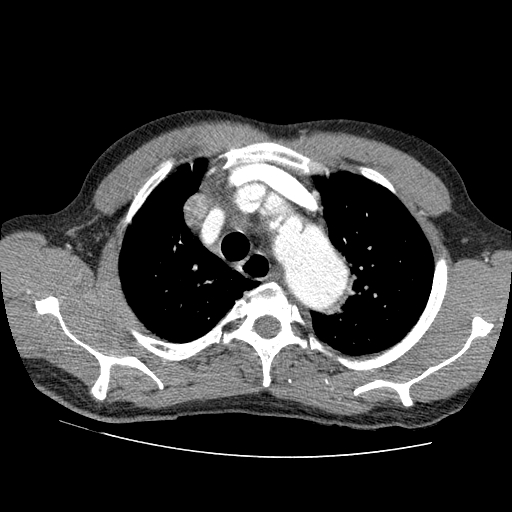File:Aortic dissection - Stanford A -DeBakey I (Radiopaedia 28339-28587 B 4).jpg