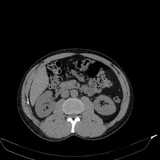 File:Aortic dissection - Stanford type A (Radiopaedia 83418-98500 Axial non-contrast 54).jpg