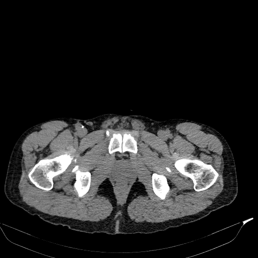 Aortic dissection - Stanford type A (Radiopaedia 83418-98500 Axial non-contrast 94).jpg