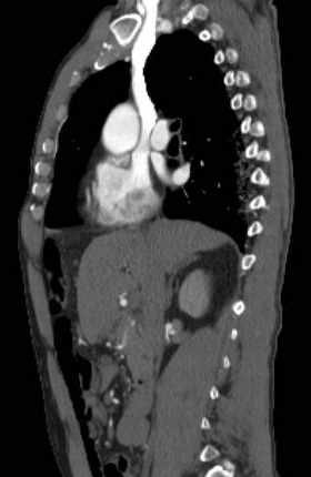 File:Aortic dissection - Stanford type B (Radiopaedia 73648-84437 C 94).jpg