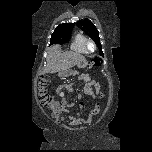 File:Aortic dissection - Stanford type B (Radiopaedia 88281-104910 B 11).jpg