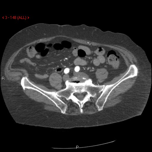 File:Aortic intramural hematoma (Radiopaedia 27746-28001 A 148).jpg