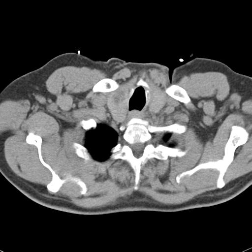 Aortic intramural hematoma (Radiopaedia 31139-31838 Axial non-contrast 5).jpg