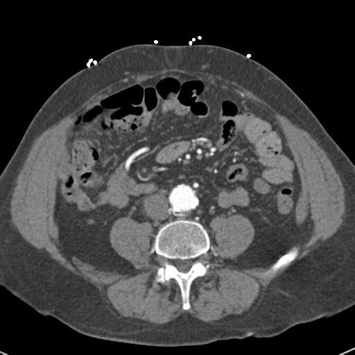 File:Aortic intramural hematoma (Radiopaedia 31139-31838 B 121).jpg