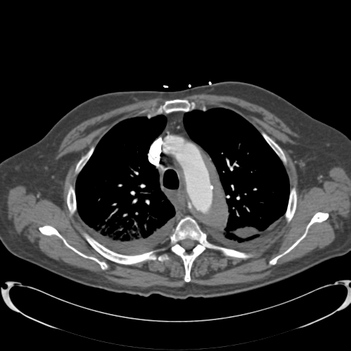 Aortic intramural hematoma (Radiopaedia 34260-35540 B 10).png