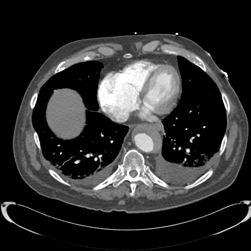 Aortic intramural hematoma (Radiopaedia 34260-35540 B 32).png