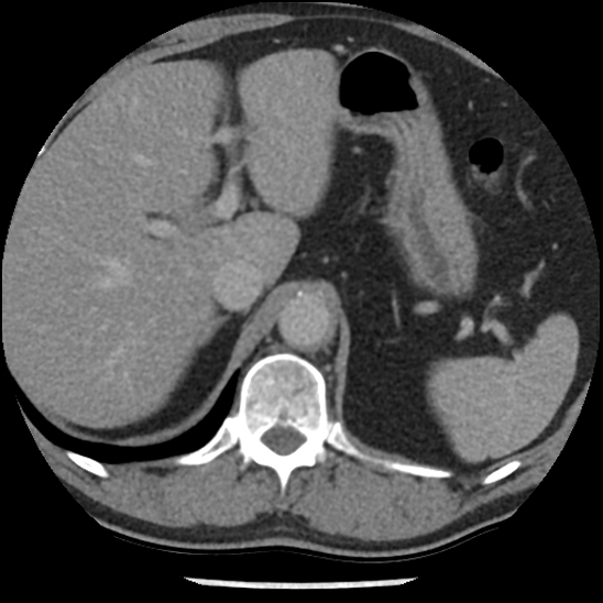 Aortic intramural hematoma (type B) (Radiopaedia 79323-92387 Axial C+ delayed 55).jpg