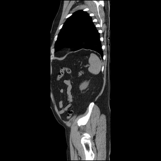 Aortic intramural hematoma (type B) (Radiopaedia 79323-92387 G 47).jpg