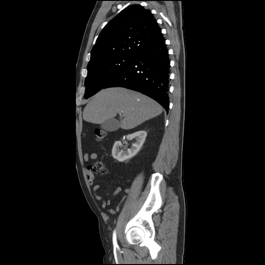 Aortic intramural hematoma (type B) (Radiopaedia 79323-92387 H 10).jpg