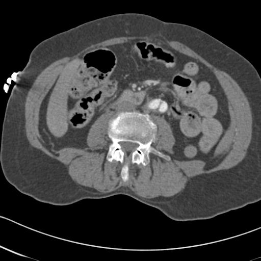 Aortic intramural hematoma from penetrating atherosclerotic ulcer (Radiopaedia 31137-31836 A 116).jpg