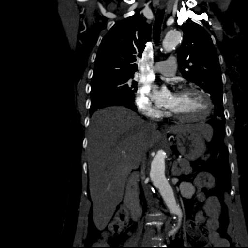File:Aortic intramural hematoma from penetrating atherosclerotic ulcer (Radiopaedia 31137-31836 C 29).jpg