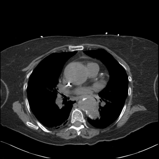 Aortic intramural hematoma with dissection and intramural blood pool (Radiopaedia 77373-89491 Axial non-contrast 51).jpg