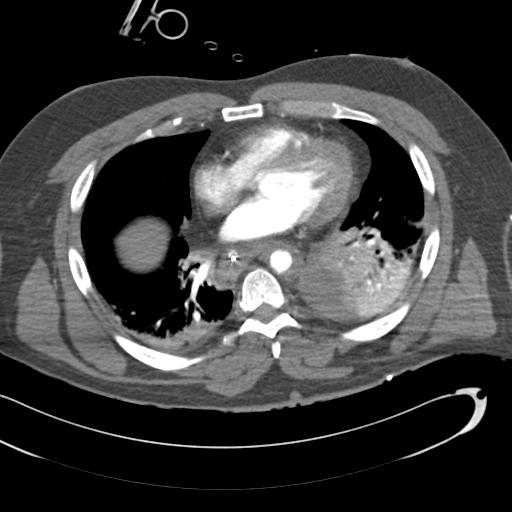 Aortic transection, diaphragmatic rupture and hemoperitoneum in a complex multitrauma patient (Radiopaedia 31701-32622 A 53).jpg