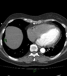 Aortic valve endocarditis (Radiopaedia 87209-103485 C 66).jpg